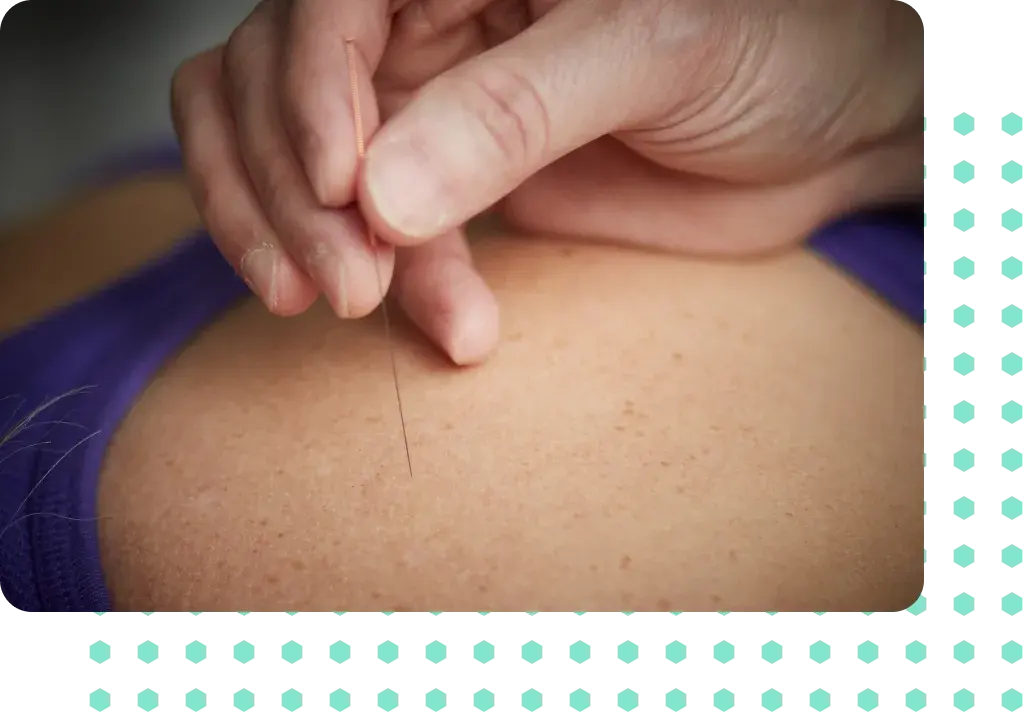 Acupuncture being performed on a womans
shoulder.